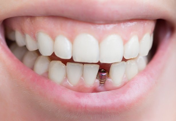 Closeup of a dental implant