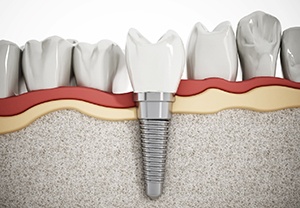 Dental implant in Pittsburgh 