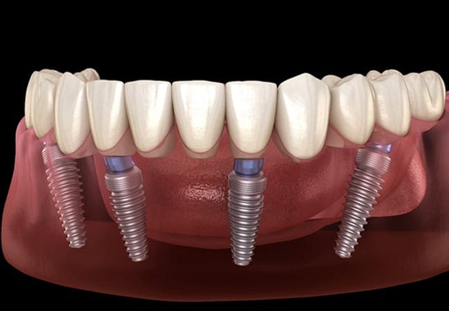 3D illustration of All-on-4 dental implants in Pittsburgh