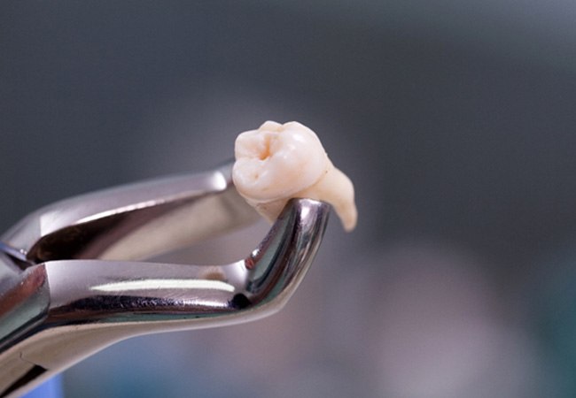 Tooth being held by dental forceps
