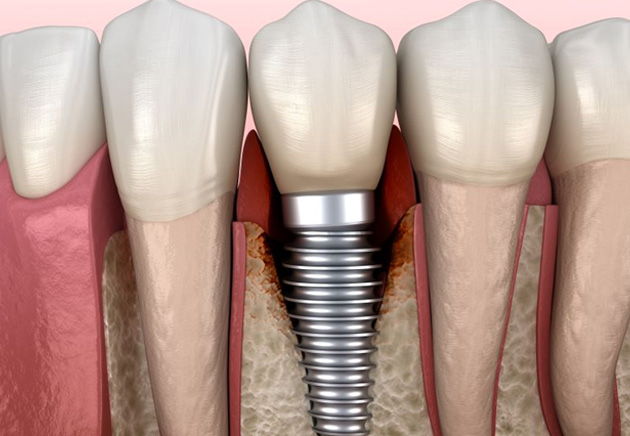 Illustration showing infected tissue around a dental implant