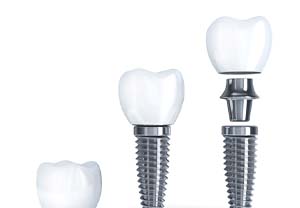 dental implant post, abutment, and crown