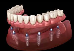 Implant denture in Pittsburgh