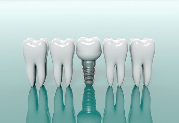 Models comparing natural teeth to dental implants in Pittsburgh