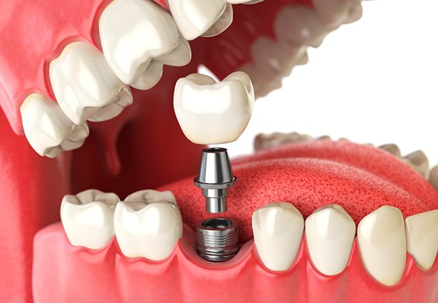 model showing how dental implants work
