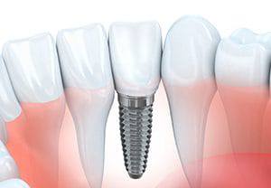 Diagram showing single tooth dental implant