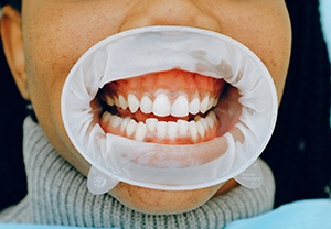 Close up of woman’s misaligned teeth