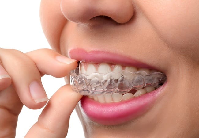 Closeup of patient placing Invisalign tray