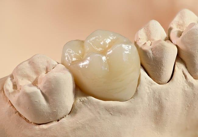 Model smile with dental crown restoration