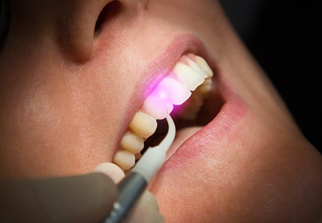 Patient receiving soft tissue laser dentistry treatment