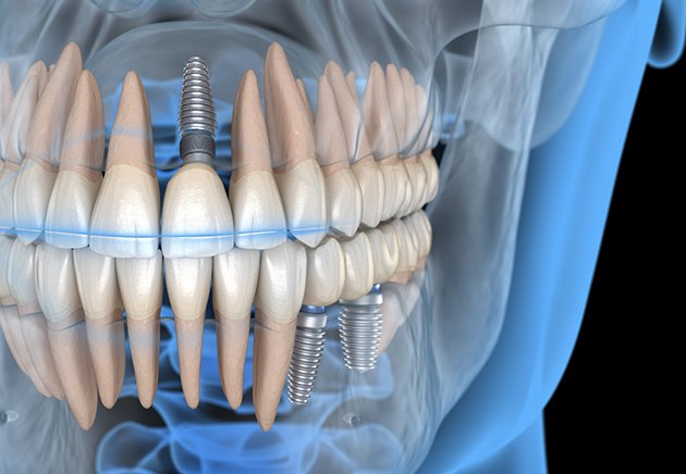 Illustration of dental implants in upper and lower dental arch