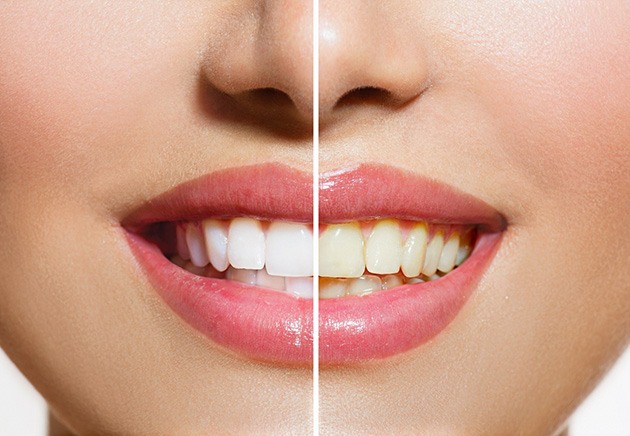 A before-and-after photo of teeth whitening in Pittsburgh