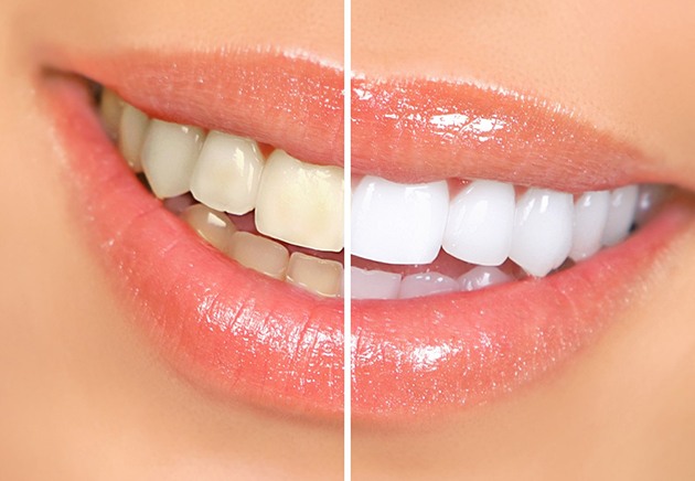 Closeup of smile before and after teeth whitening treatment
