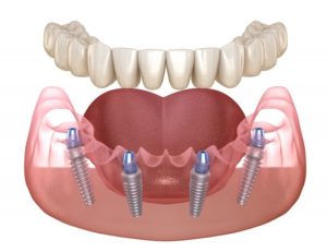 Illustration of lower arch All-on-4 dental implants in Pittsburgh