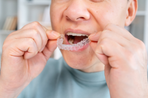 a closeup of an Invisalign aligner