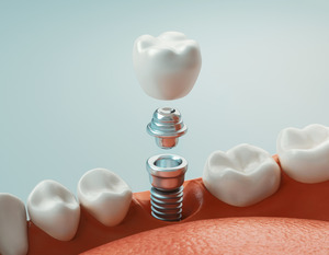 3D render of a dental implant