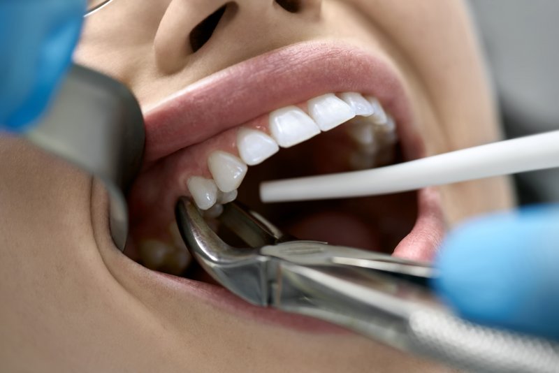 Dentist performing a tooth extraction